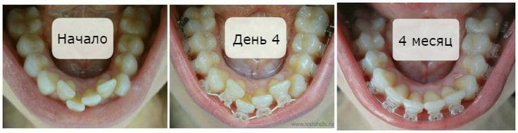 сапфірова брекет система
